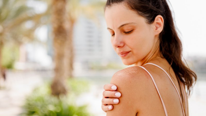 Mulher manifesta sintomas na pele devido a medicamentos que causam sensibilidade ao sol