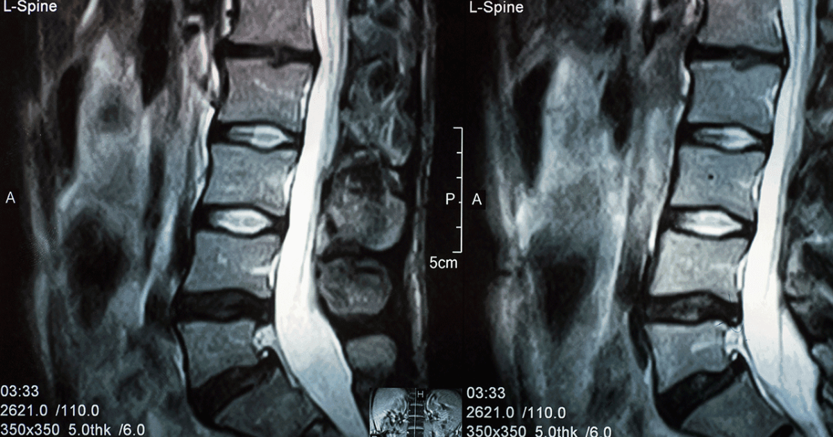 Hérnia discal lombar - Porto Spine Unit