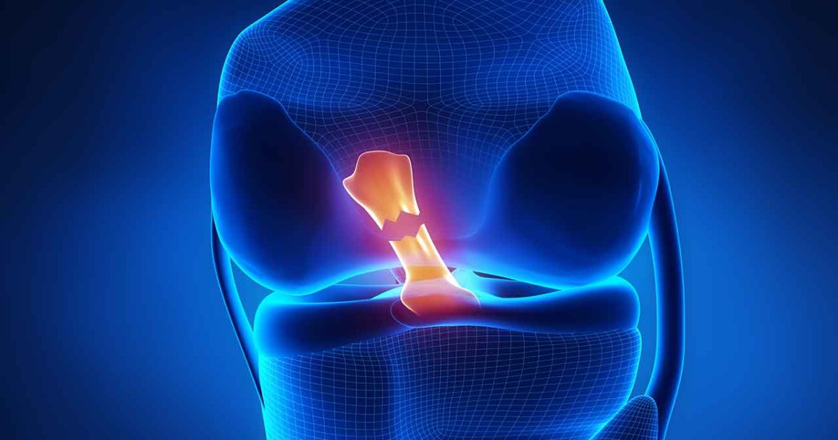 Rotura De Ligamentos O Que é Sintomas E Tratamento Cuf